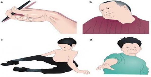 Acute dystonia (2)