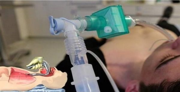 Adult orothracheal intubation Adult orothracheal intubation
