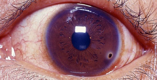 Corneal foreign body