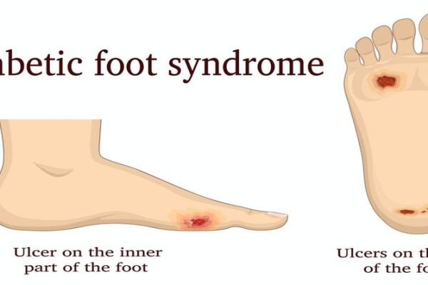 Diabetic Foot