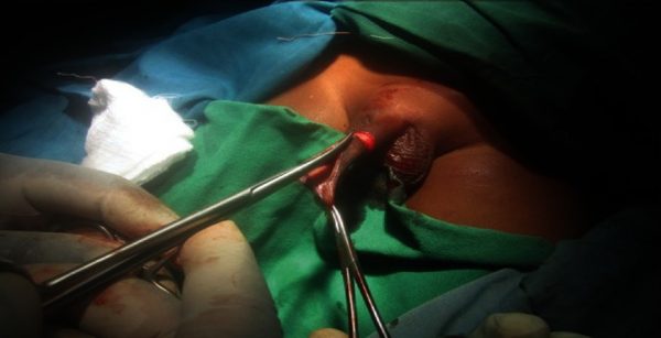 Dorsal slit procedure
