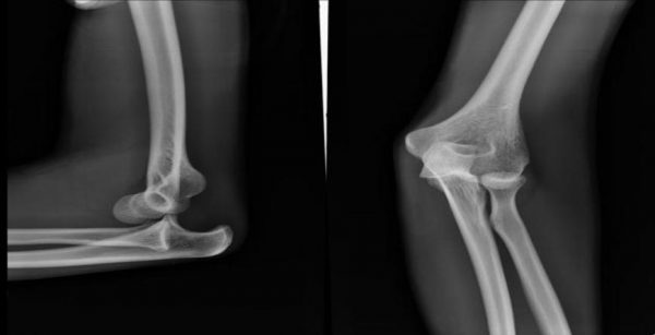 Elbow Dislocation Reduction in adult