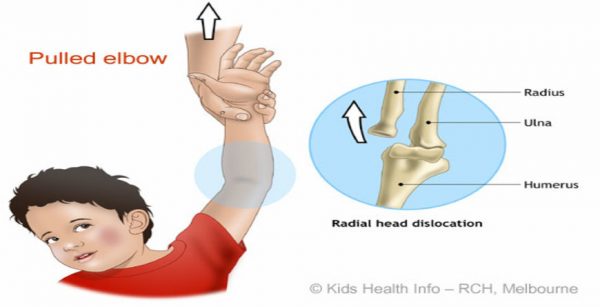 Elbow Dislocation Reduction in child