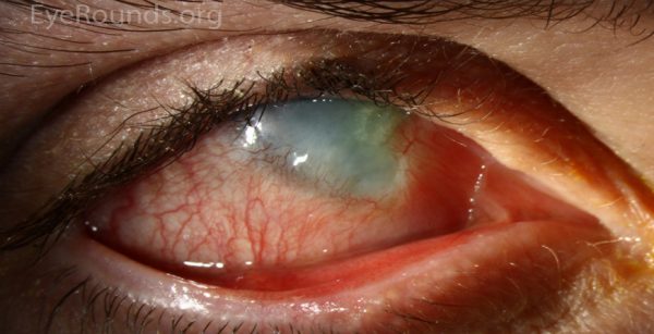 Eye chemical burn 1
