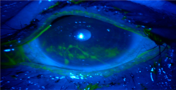 Fluorescein Eye Stain Test