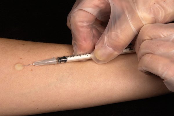 PPD Test