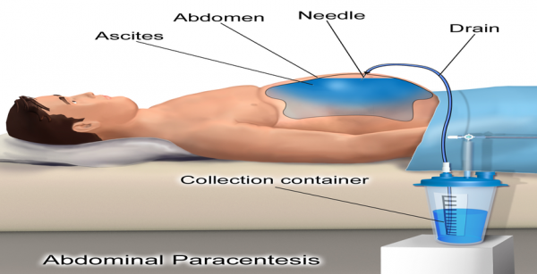 Paracentesis #Ascitic tap