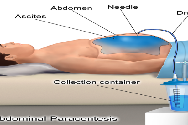 Paracentesis #Ascitic tap