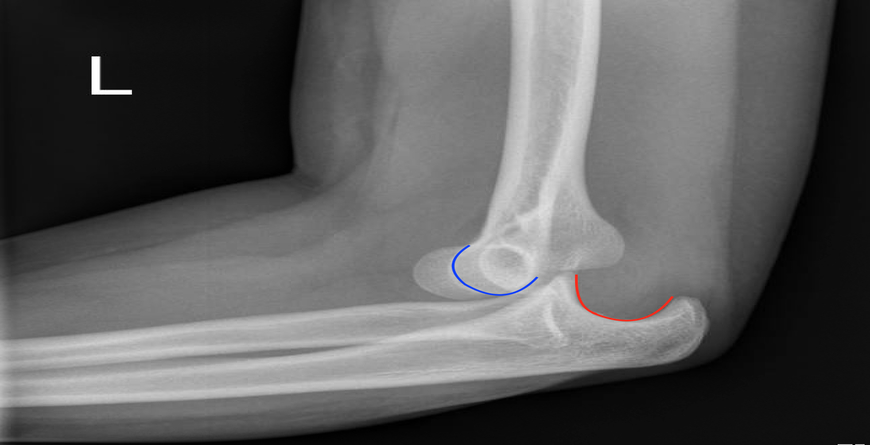 Posterior Elbow Dislocation & Reduction - DarmanX Academy