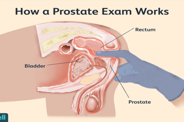 Prostate Examination