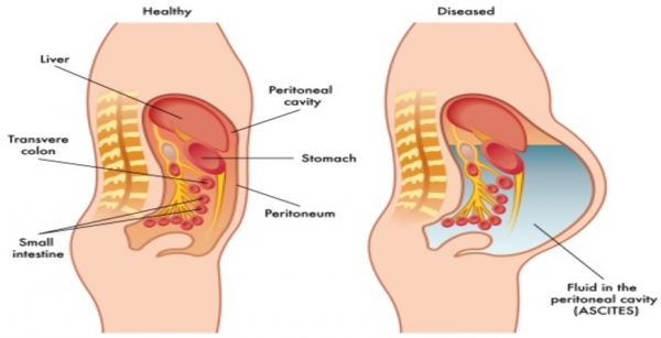 Removal Abdominal Fluid or Ascites - Paracentesis