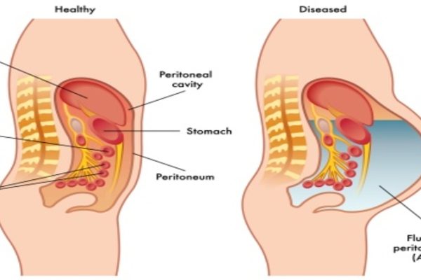 Removal Abdominal Fluid or Ascites - Paracentesis