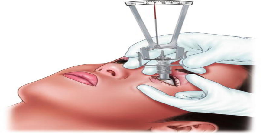 Schiotz Tonometer Darmanx Academy