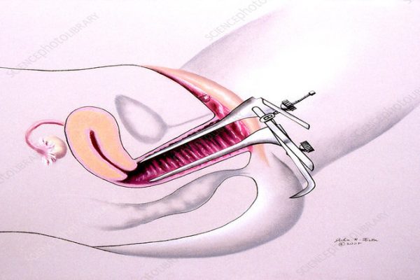 Speculum Exam