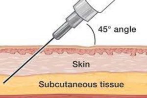 Subcunateous injection