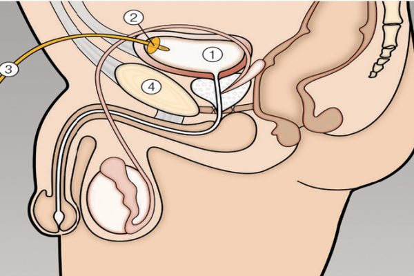 Suprapubic Catheterizaton