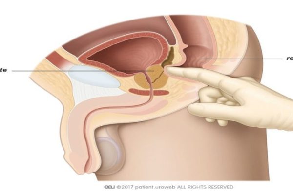 TR (Digital rectal examination)
