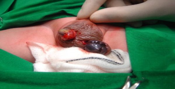 Testis torsion operation Testis torsion operation