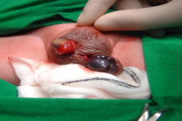 Testis torsion operation