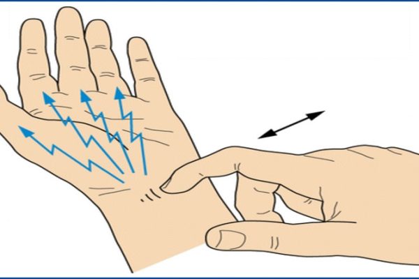 Tinels test for carpal tunnel syndrome