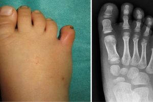 Toe dislocation and reduction