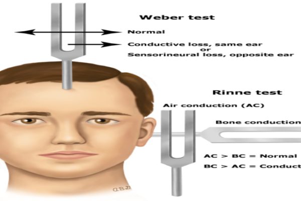 Weber and Rinne test