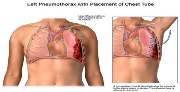 chest tube insertion (2) chest tube insertion