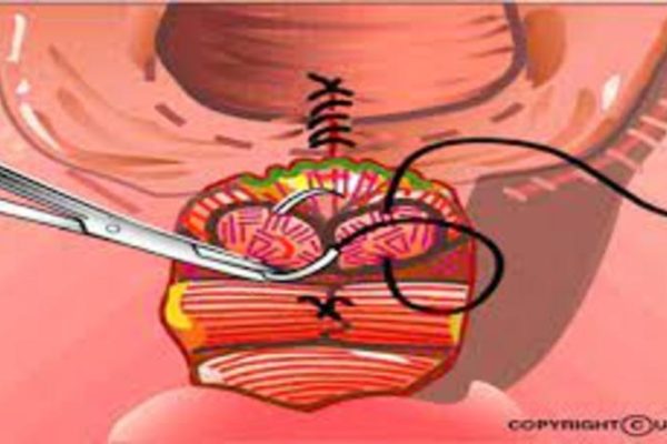 perineal repair due to episiotomy