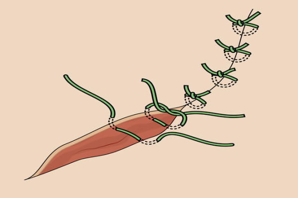 single interrupted suture