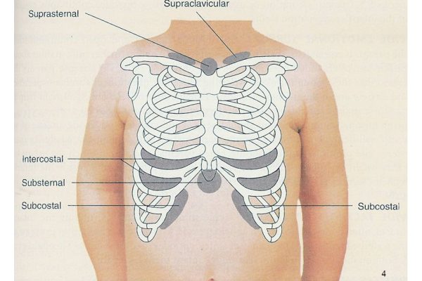 nasal flaring + Suprasternal retractions