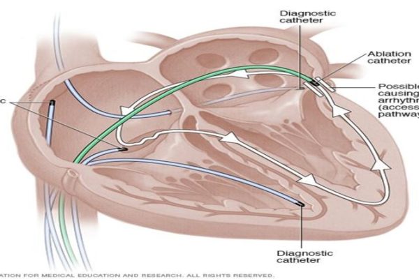 Catheter Ablation Procedure